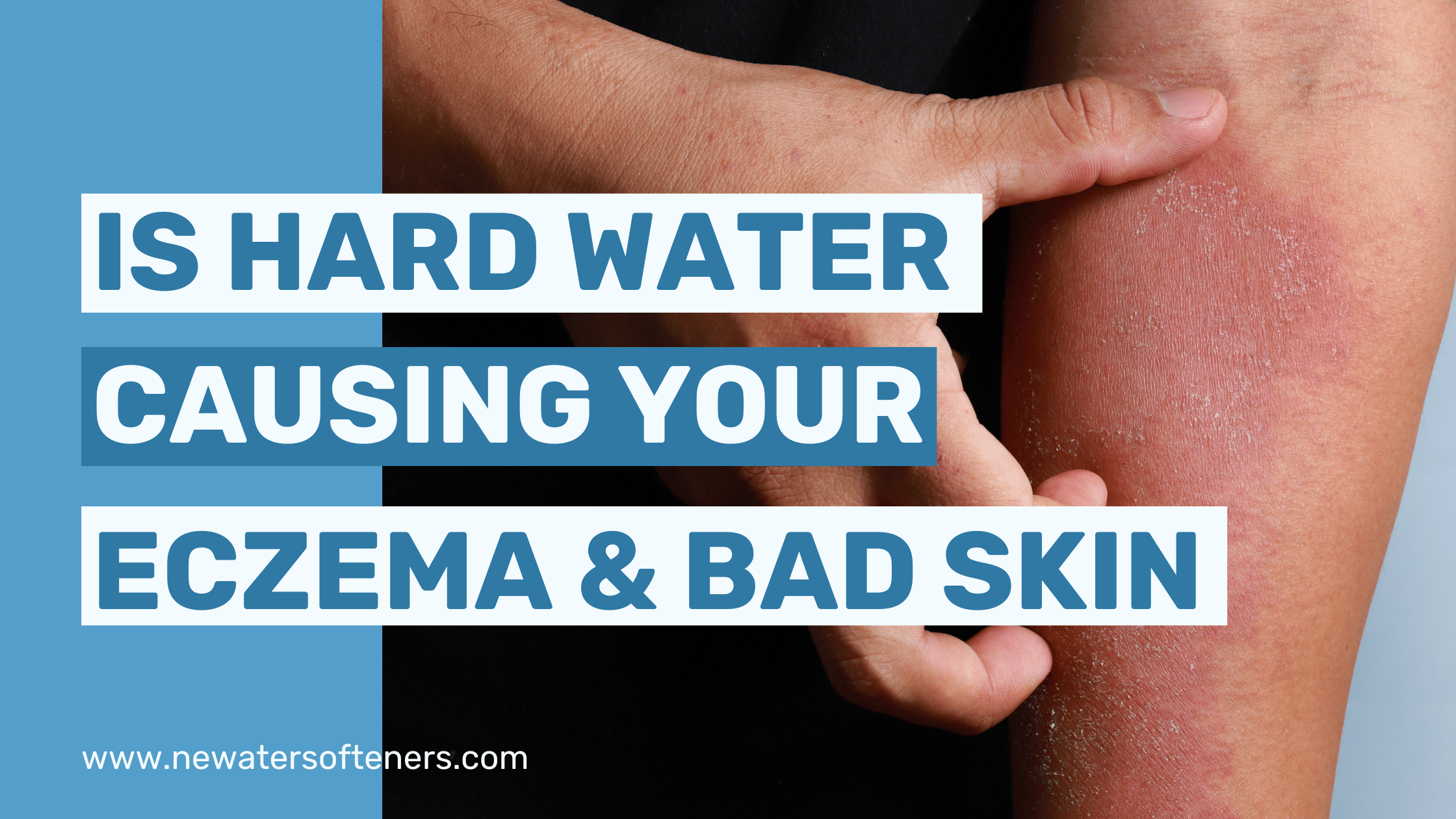 Is Hard Water Causing Your Bad Skin & Eczema?