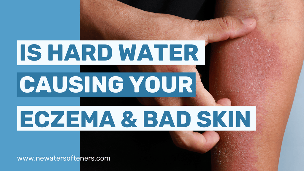 Is Hard Water Causing Your Bad Skin & Eczema?