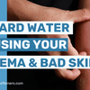 Is Hard Water Causing Your Bad Skin & Eczema?
